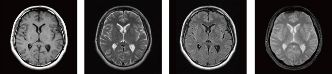 頭部MRI（脳実質の断面像）