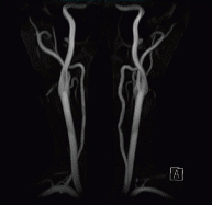 頸部MRA（頸動脈の血管像）