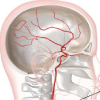 頸動脈ステント術について