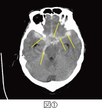 脳動脈瘤（図①）