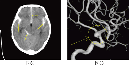 CTスキャン（図②）とMRA（図③）