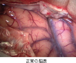 正常の脳表