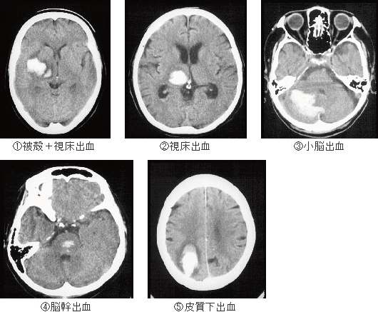 ①被殻＋視床出血、②視床出血、③小脳出血、④脳幹出血、⑤皮質下出血