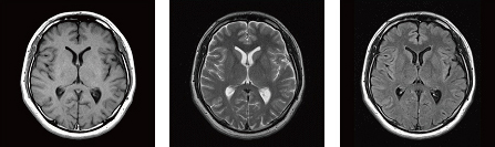 頭部MRI撮影