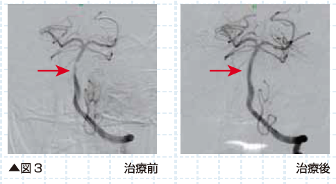 頭蓋内動脈狭窄症に対する脳血管内治療（カテーテル治療）について