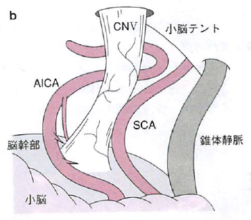 顔の痛みについて（三叉神経痛）