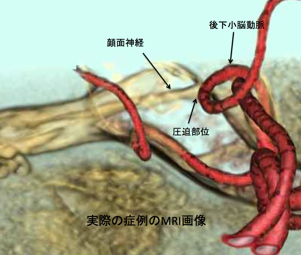 顔面けいれんについて