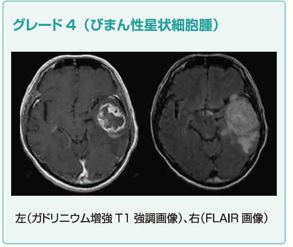 グリオーマ（神経膠腫）