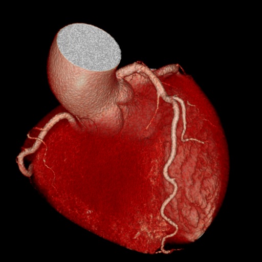 心臓冠動脈CT